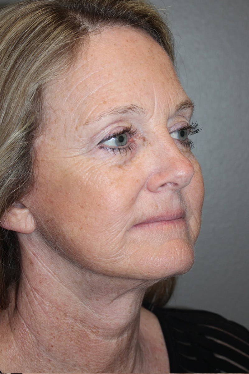 Facelift Before & After Gallery - Patient 174901088 - Image 4