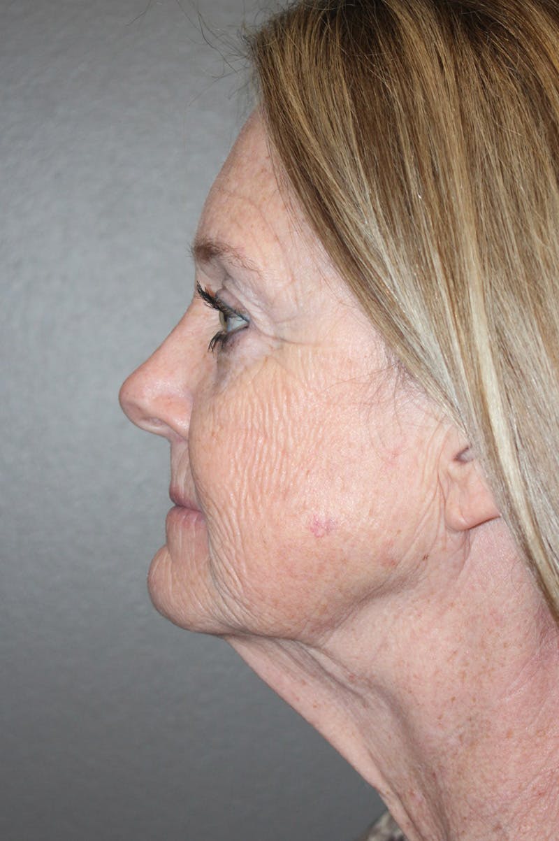 Facelift Before & After Gallery - Patient 174901088 - Image 9