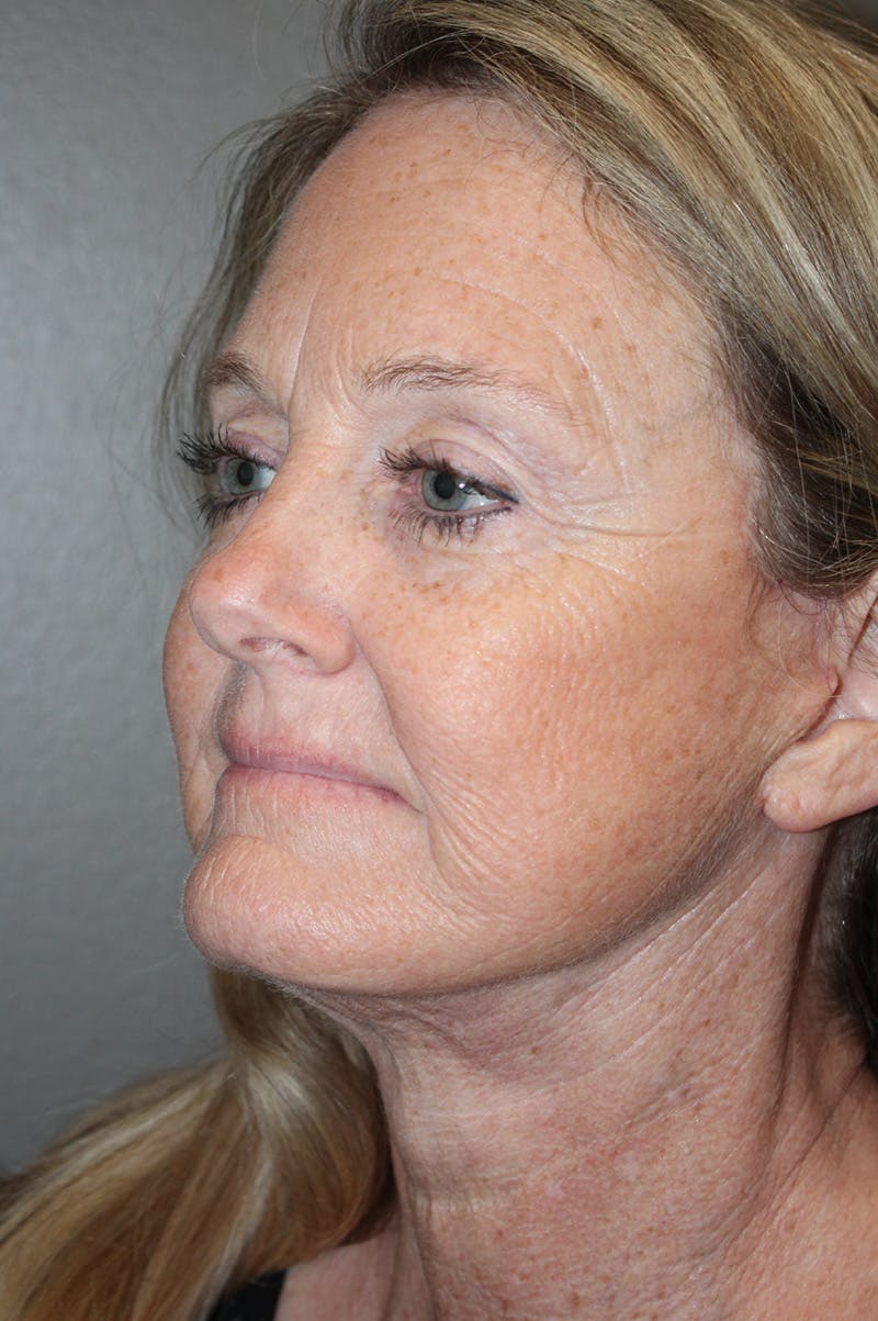 Facelift Before & After Gallery - Patient 174901088 - Image 8