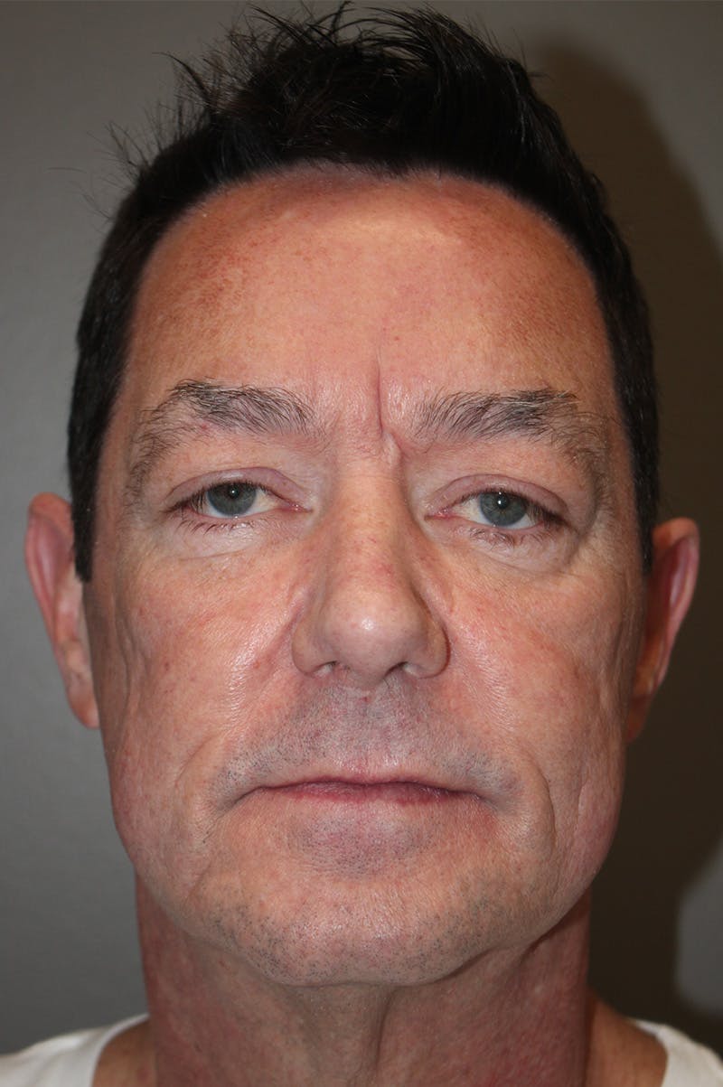 Facelift Before & After Gallery - Patient 174901087 - Image 1