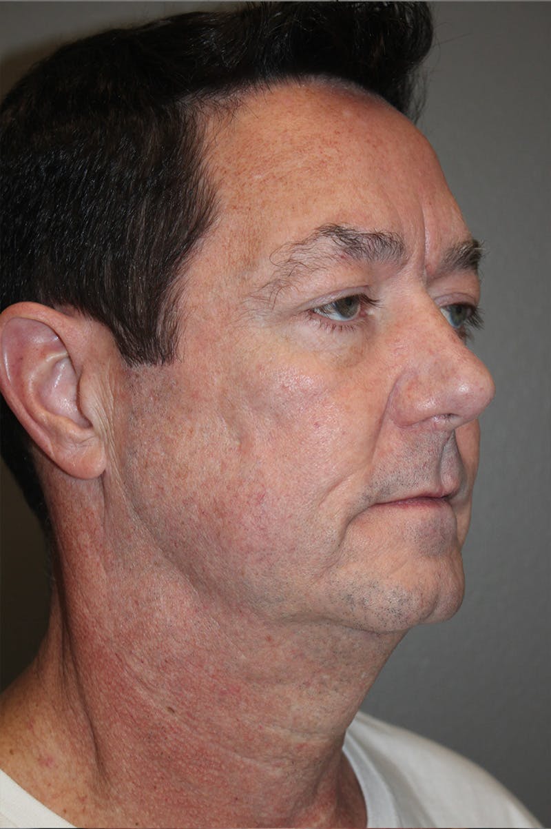 Facelift Before & After Gallery - Patient 174901087 - Image 3