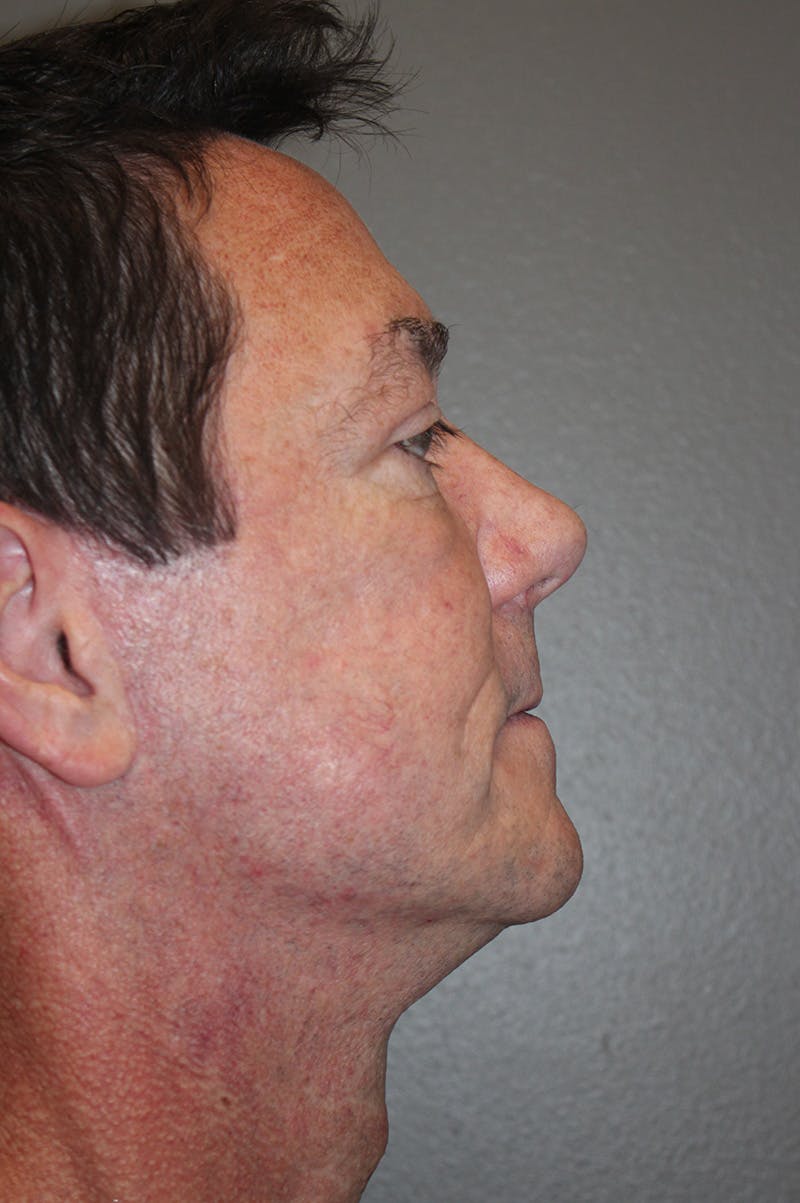 Facelift Before & After Gallery - Patient 174901087 - Image 6