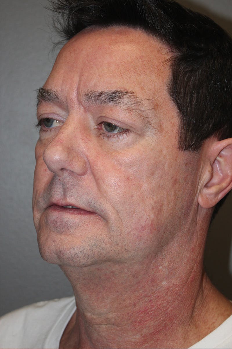 Facelift Before & After Gallery - Patient 174901087 - Image 7
