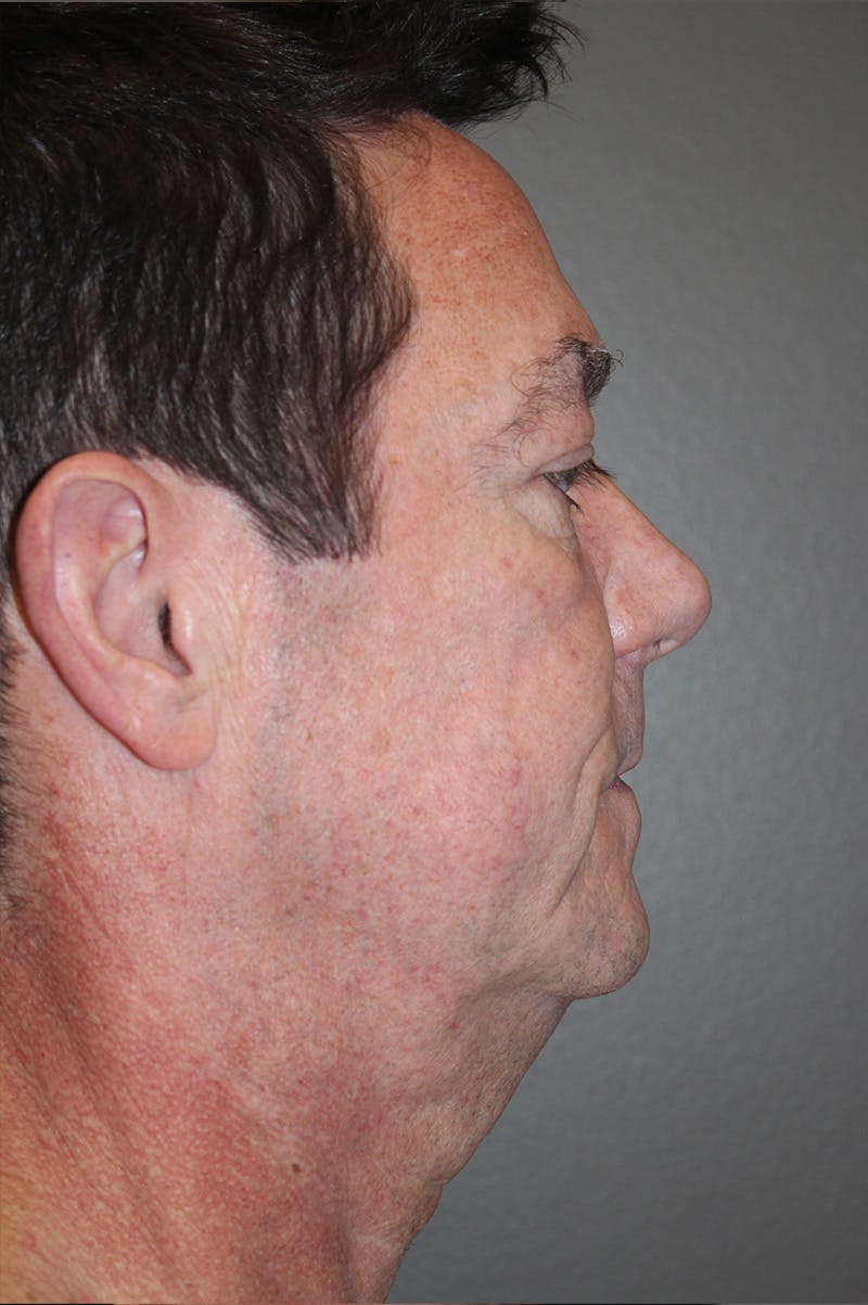 Facelift Before & After Gallery - Patient 174901087 - Image 5