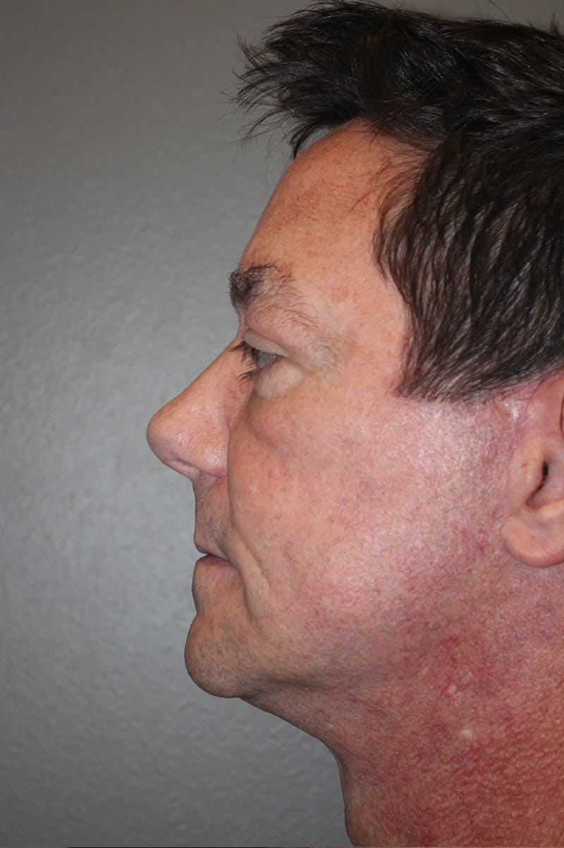 Facelift Before & After Gallery - Patient 174901087 - Image 10