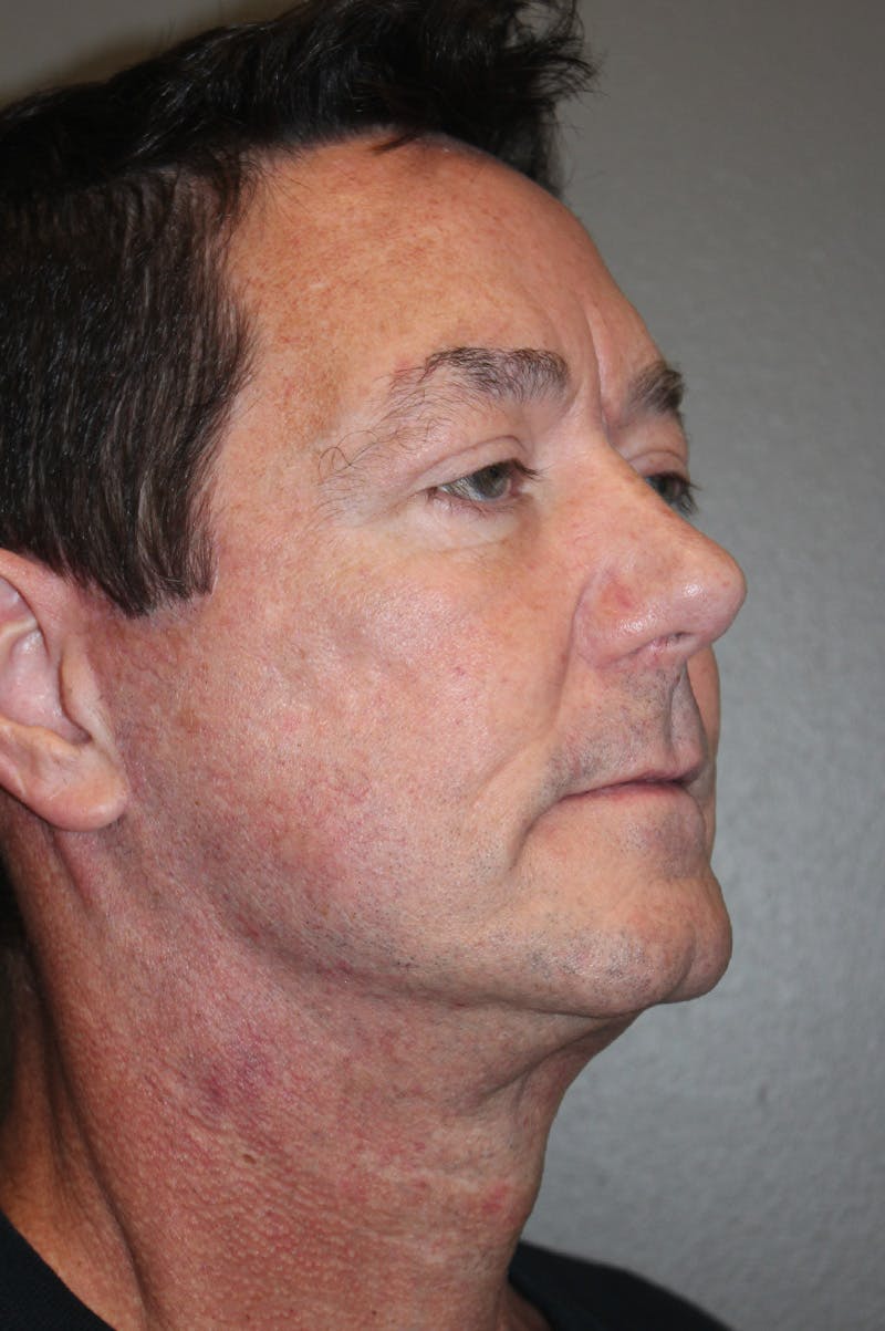 Facelift Before & After Gallery - Patient 174901087 - Image 4