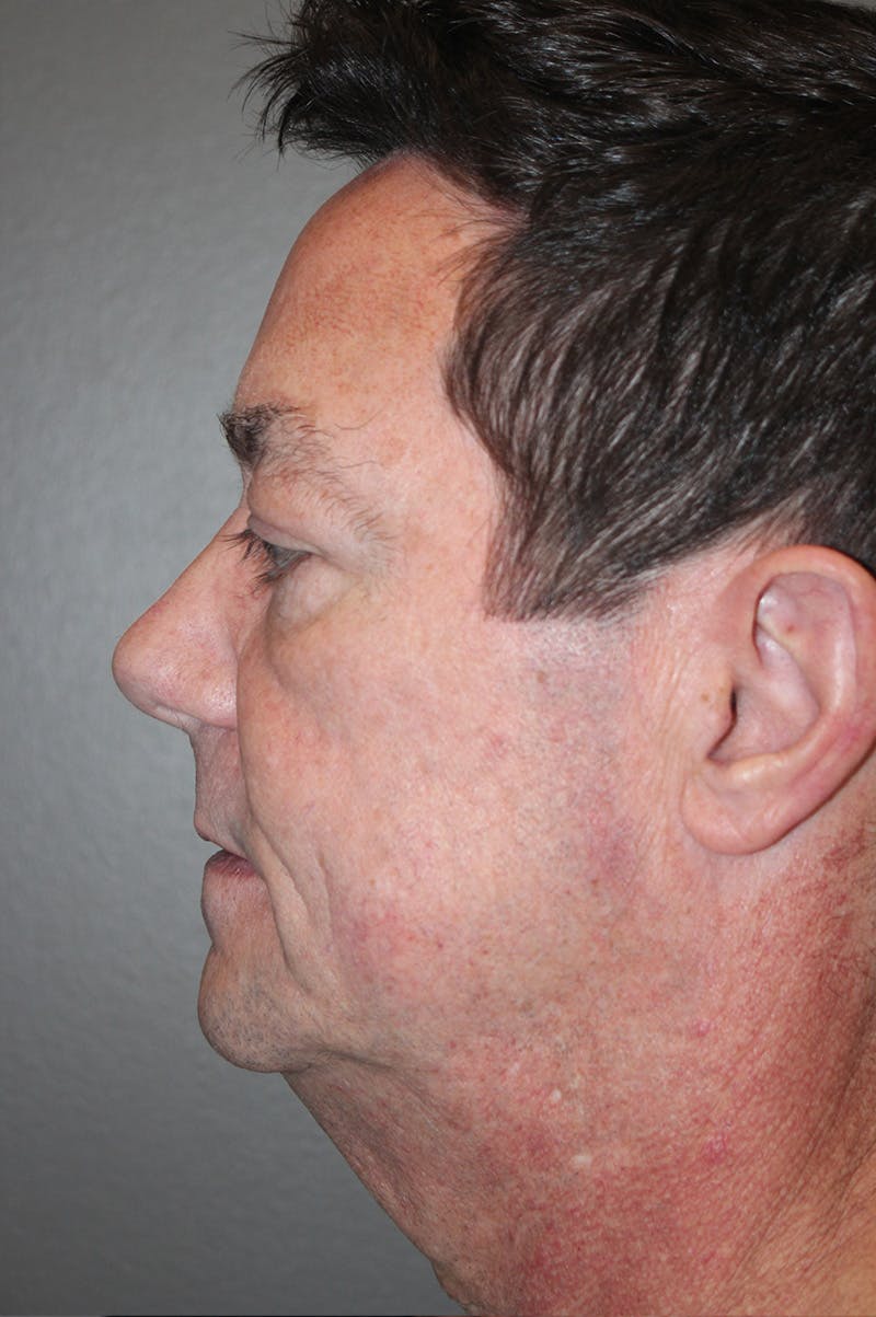 Facelift Before & After Gallery - Patient 174901087 - Image 9