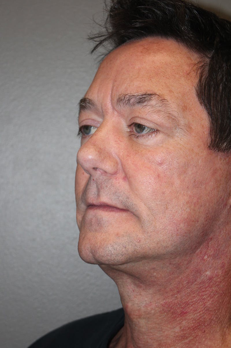 Facelift Before & After Gallery - Patient 174901087 - Image 8