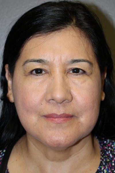 Brow/Forehead Before & After Gallery - Patient 174901112 - Image 1