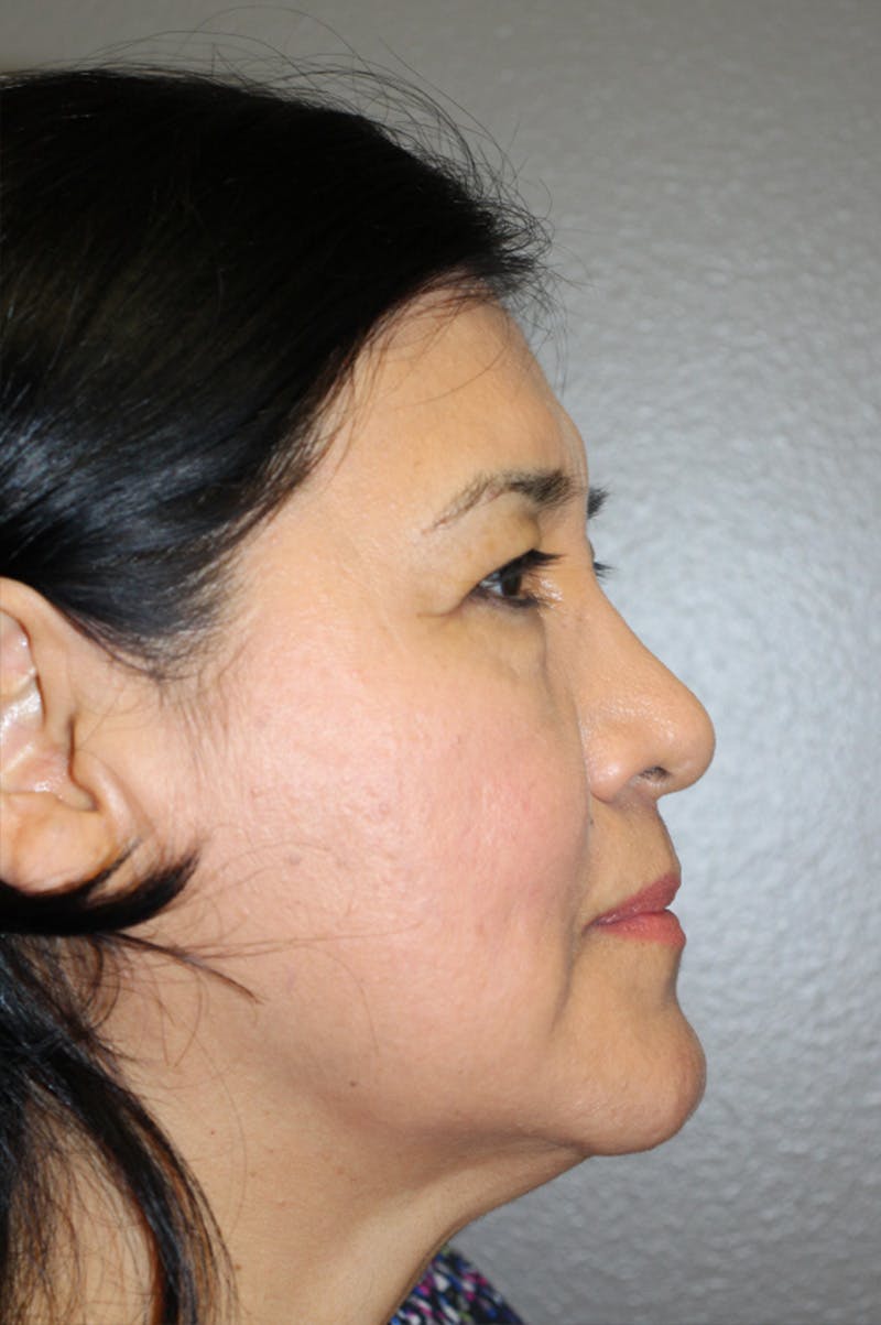 Brow/Forehead Before & After Gallery - Patient 174901112 - Image 3