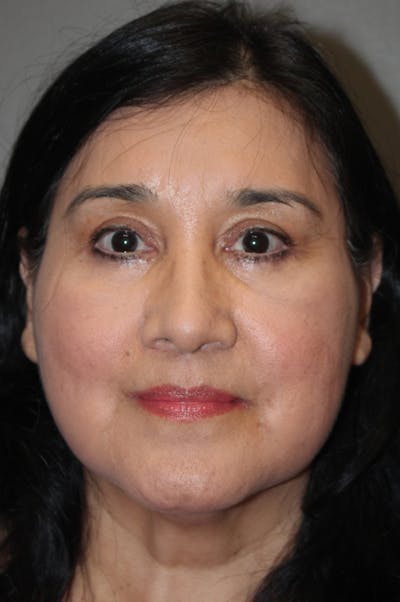 Brow/Forehead Before & After Gallery - Patient 174901112 - Image 2