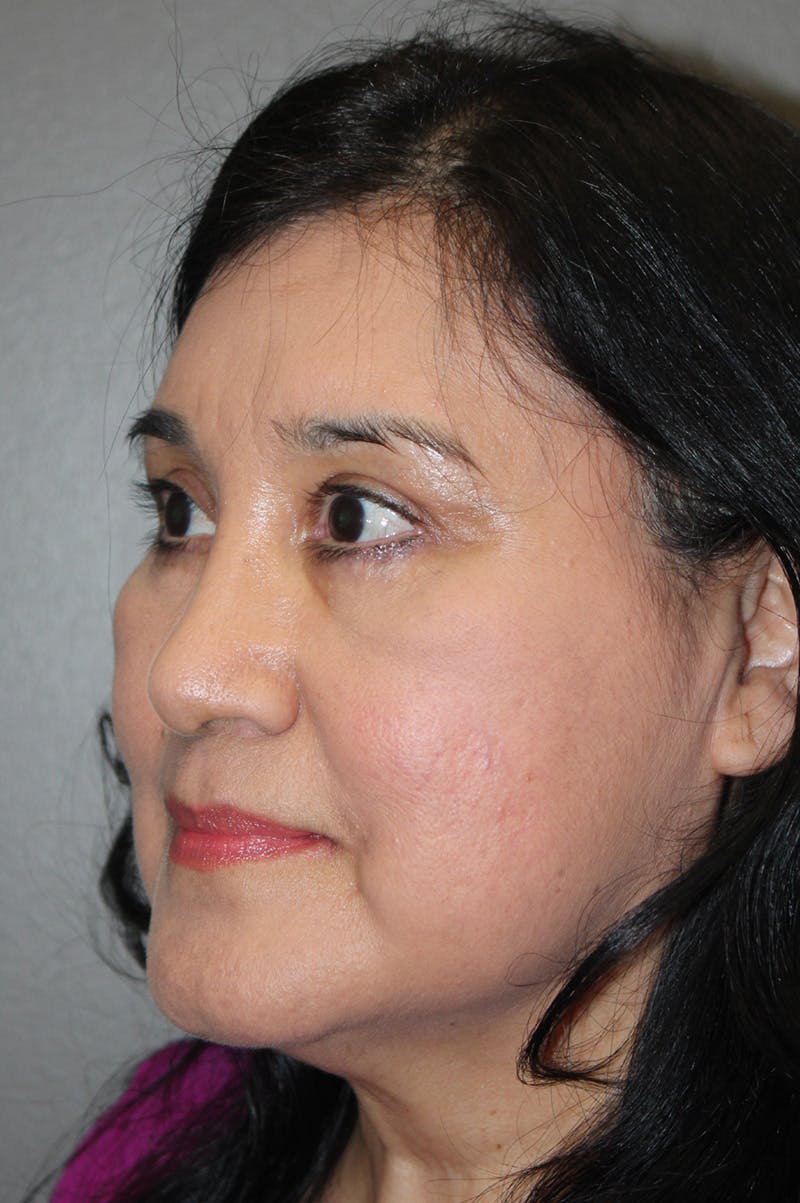 Brow/Forehead Before & After Gallery - Patient 174901112 - Image 6
