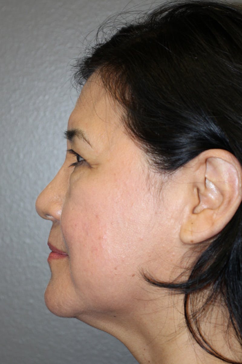 Brow/Forehead Before & After Gallery - Patient 174901112 - Image 7