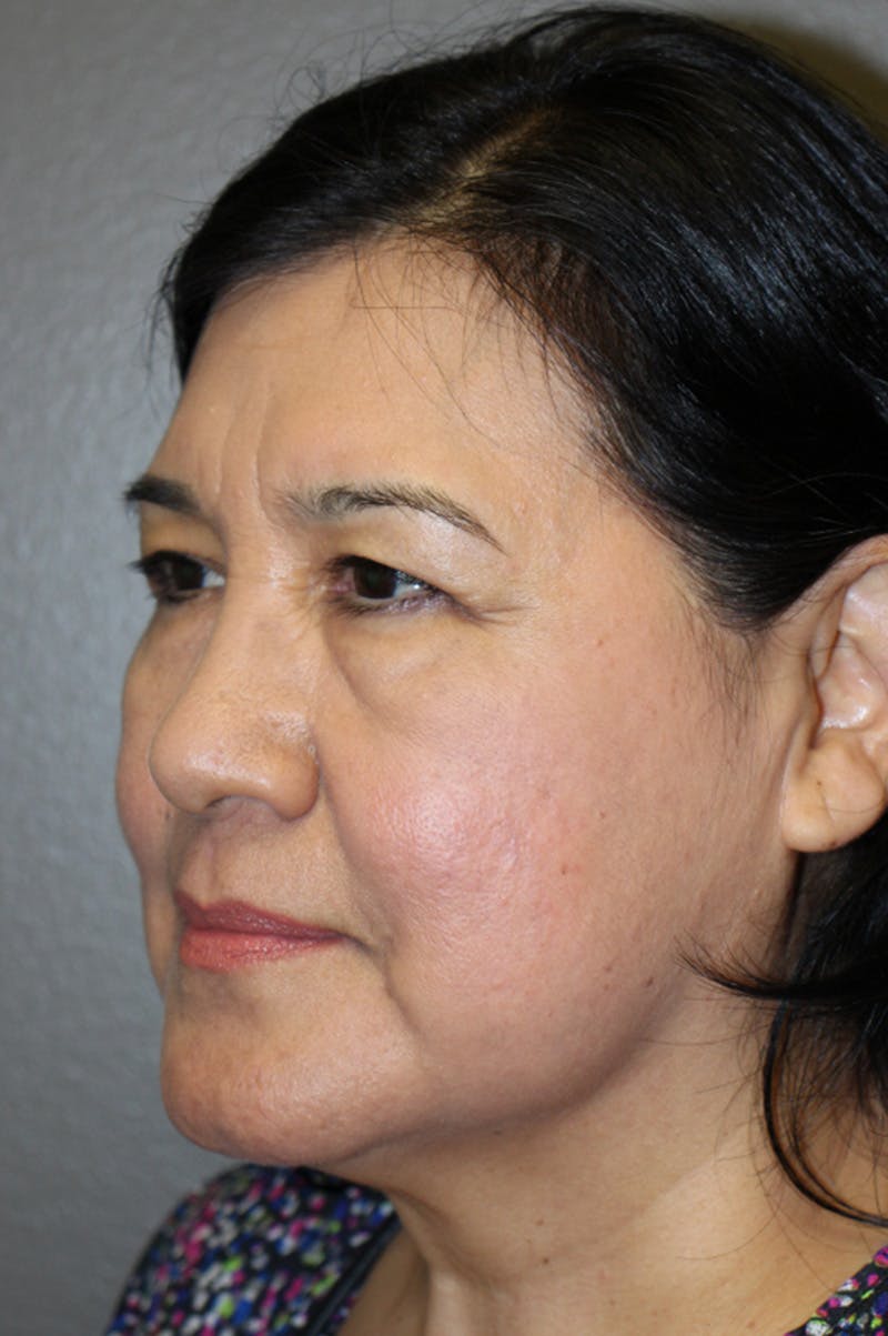 Brow/Forehead Before & After Gallery - Patient 174901112 - Image 5