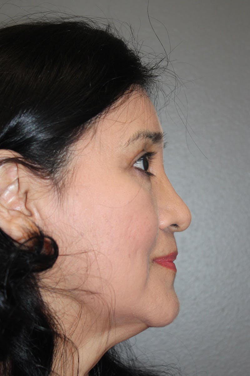 Brow/Forehead Before & After Gallery - Patient 174901112 - Image 4