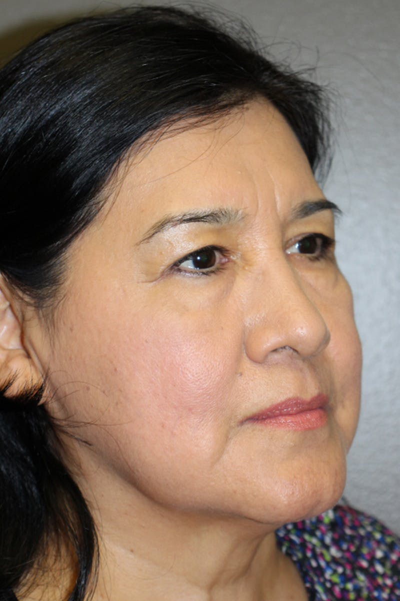 Mid-face lift Before & After Gallery - Patient 174901505 - Image 9