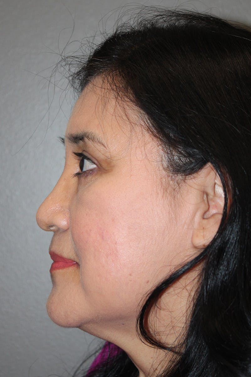 Brow/Forehead Before & After Gallery - Patient 174901112 - Image 8