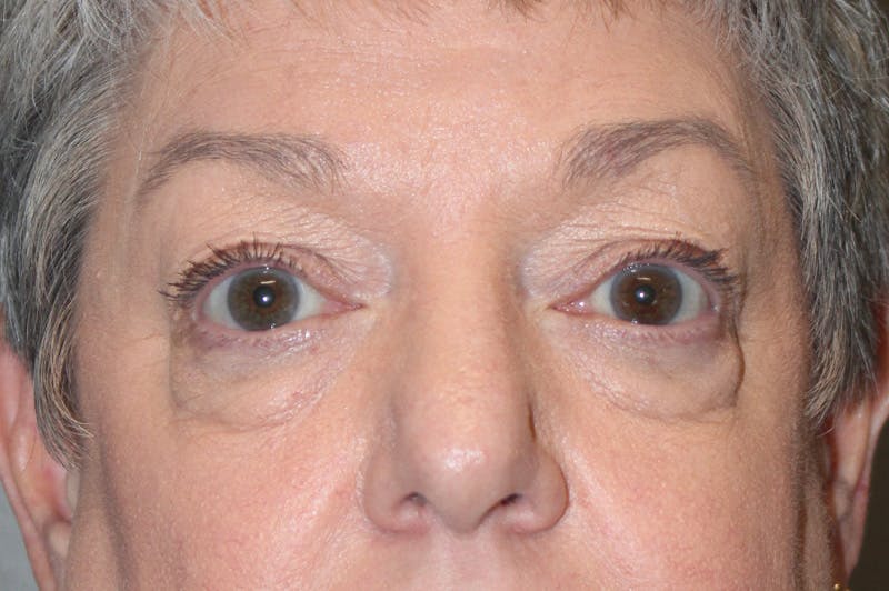 Eyelid surgery Before & After Gallery - Patient 174901502 - Image 1