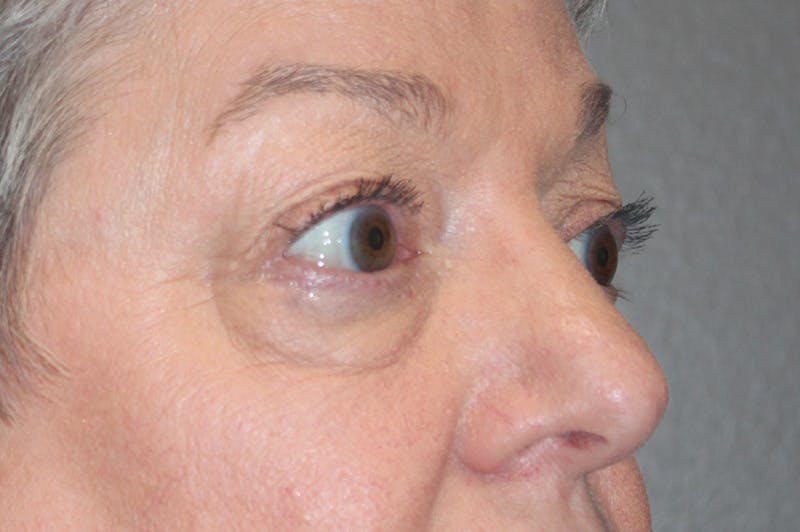 Eyelid surgery Before & After Gallery - Patient 174901502 - Image 3