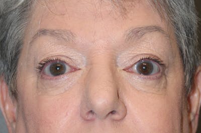 Eyelid surgery Before & After Gallery - Patient 174901502 - Image 2