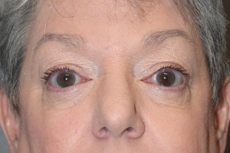 Eyelid surgery Before & After Gallery - Patient 174901502 - Image 2