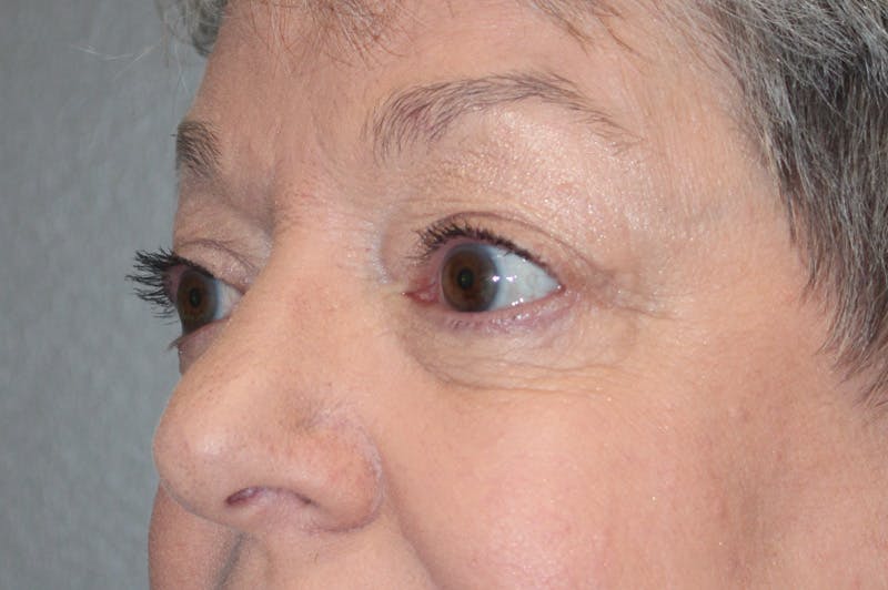 Eyelid surgery Before & After Gallery - Patient 174901502 - Image 6