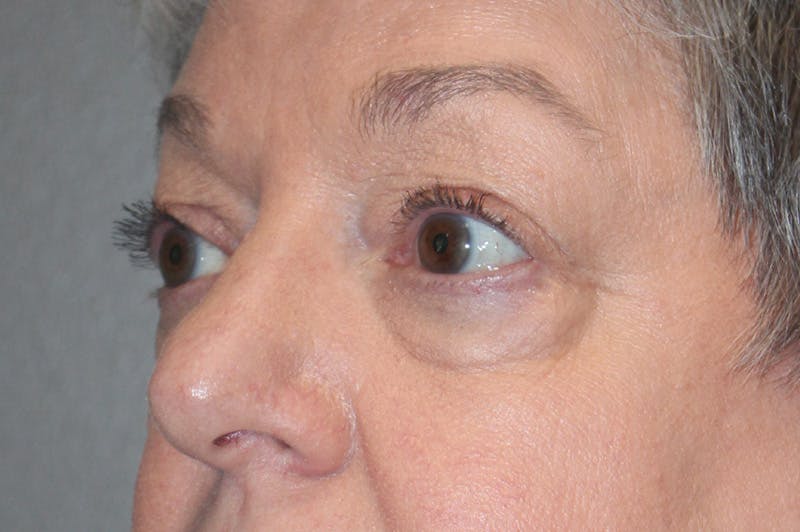 Eyelid surgery Before & After Gallery - Patient 174901502 - Image 5