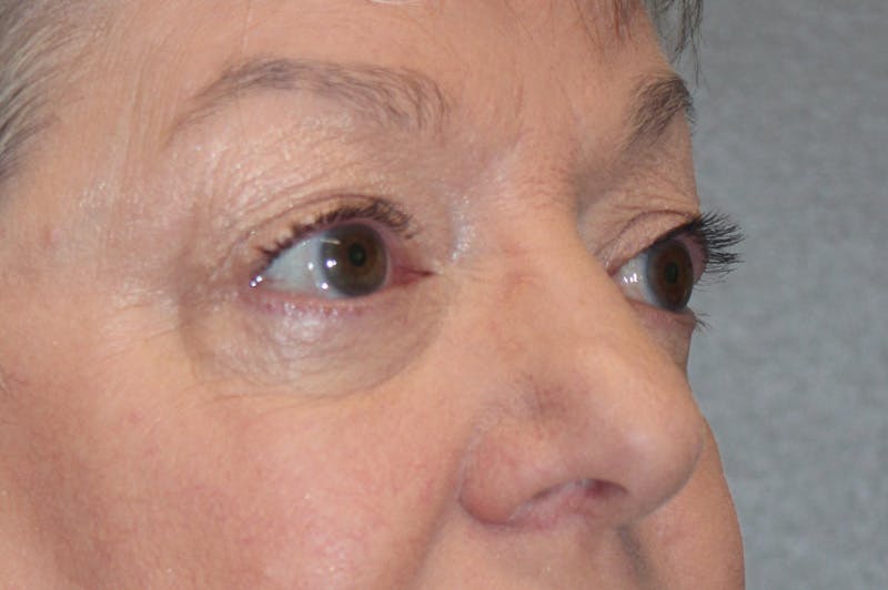 Eyelid surgery Before & After Gallery - Patient 174901502 - Image 4
