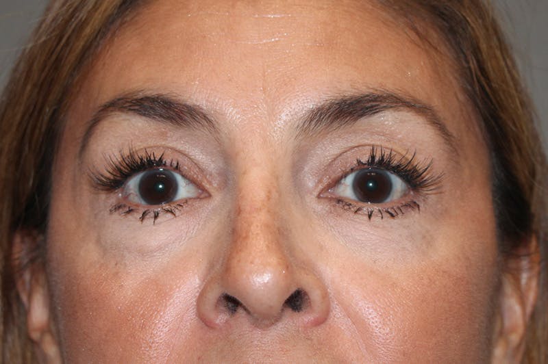 Eyelid surgery Before & After Gallery - Patient 174901501 - Image 1