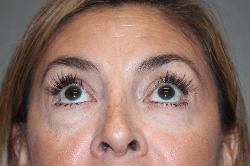 Eyelid surgery Before & After Gallery - Patient 174901501 - Image 3