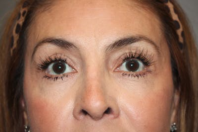 Eyelid surgery Before & After Gallery - Patient 174901501 - Image 2