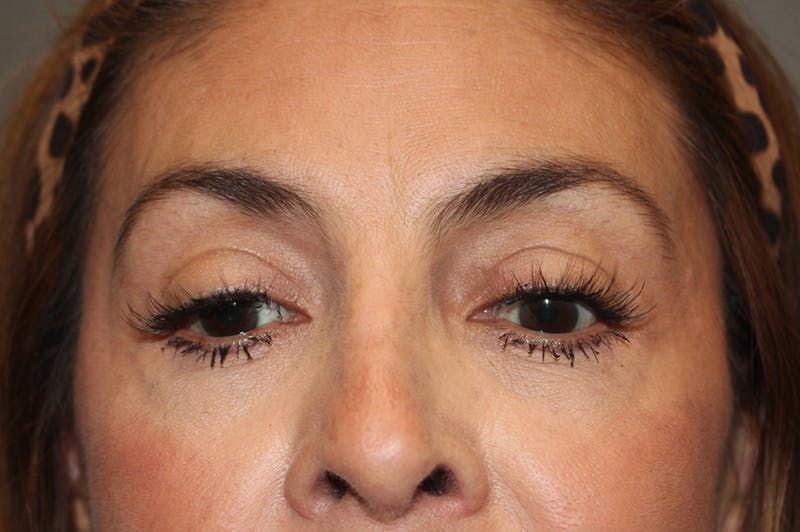 Eyelid surgery Before & After Gallery - Patient 174901501 - Image 6