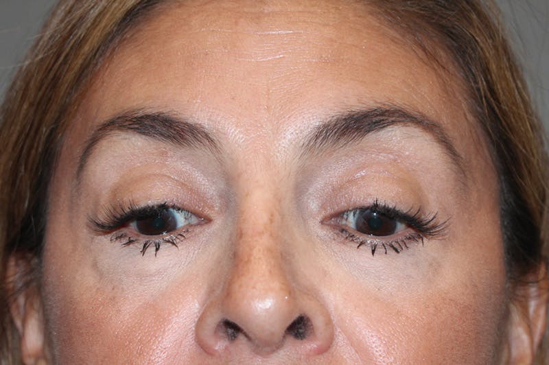 Eyelid surgery Before & After Gallery - Patient 174901501 - Image 5