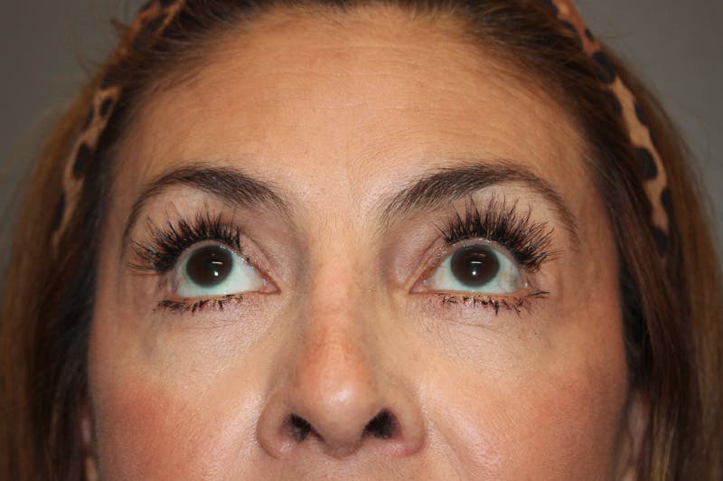 Eyelid surgery Before & After Gallery - Patient 174901501 - Image 4