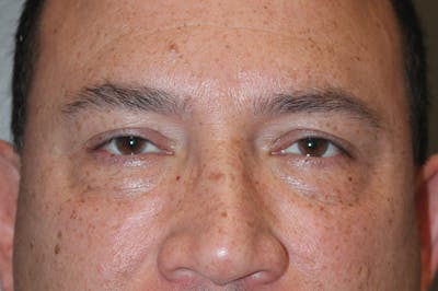 Eyelid surgery Before & After Gallery - Patient 174901503 - Image 1