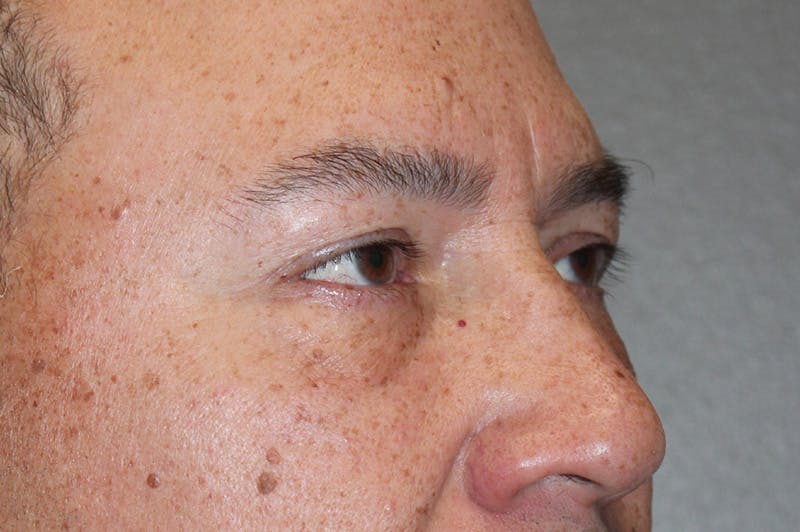 Eyelid surgery Before & After Gallery - Patient 174901503 - Image 3