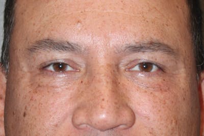 Eyelid surgery Before & After Gallery - Patient 174901503 - Image 2