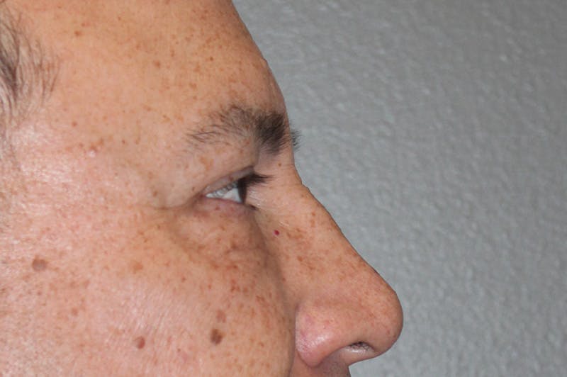 Eyelid surgery Before & After Gallery - Patient 174901503 - Image 6