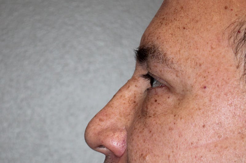 Eyelid surgery Before & After Gallery - Patient 174901503 - Image 7