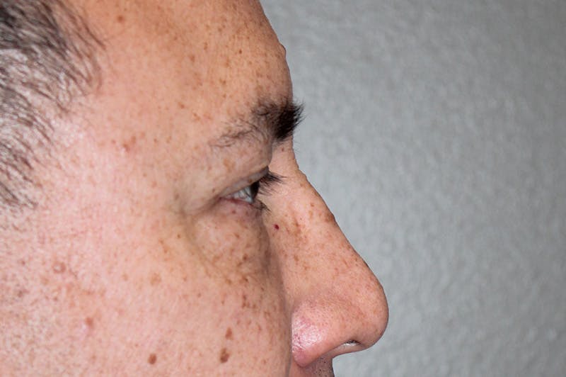 Eyelid surgery Before & After Gallery - Patient 174901503 - Image 5