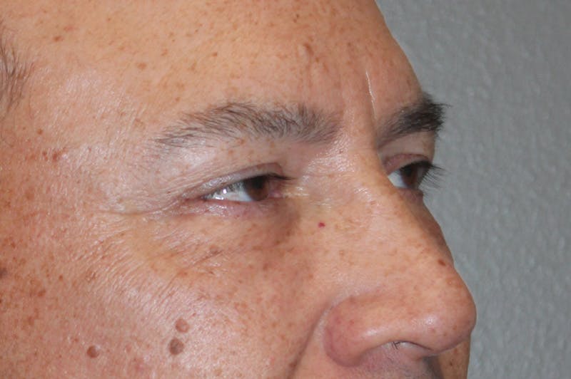 Eyelid surgery Before & After Gallery - Patient 174901503 - Image 4