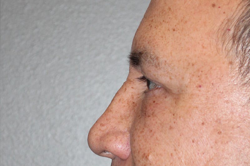 Eyelid surgery Before & After Gallery - Patient 174901503 - Image 8