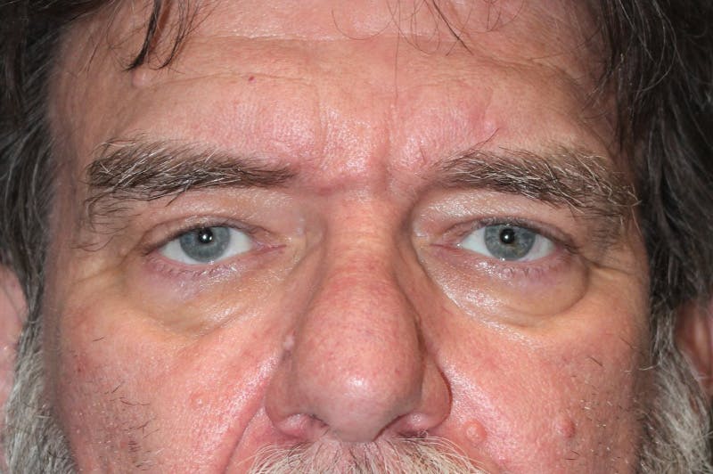 Eyelid surgery Before & After Gallery - Patient 174901504 - Image 1