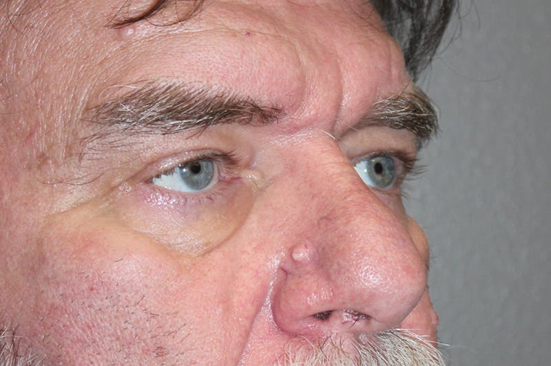 Eyelid surgery Before & After Gallery - Patient 174901504 - Image 3