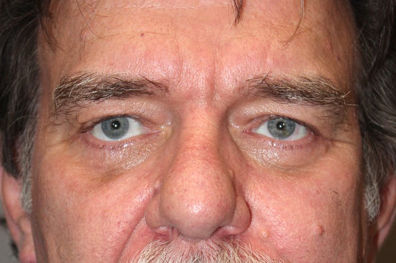 Eyelid surgery Before & After Gallery - Patient 174901504 - Image 2