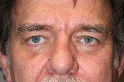 Eyelid surgery Before & After Gallery - Patient 174901504 - Image 2