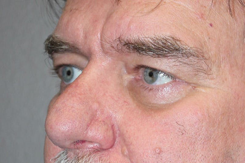 Eyelid surgery Before & After Gallery - Patient 174901504 - Image 6