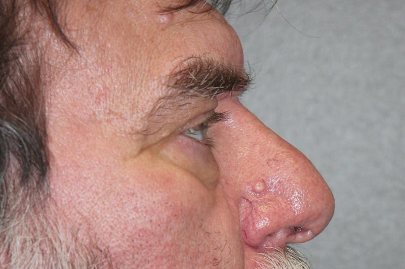 Eyelid surgery Before & After Gallery - Patient 174901504 - Image 7