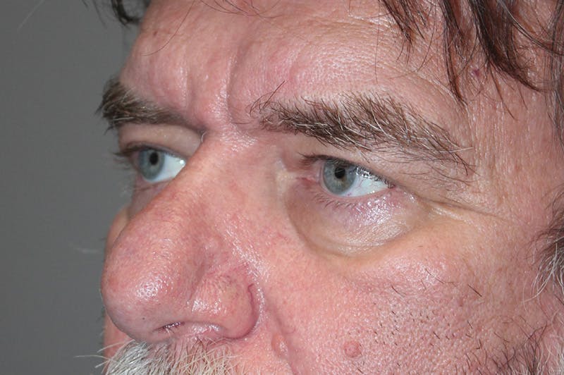 Eyelid surgery Before & After Gallery - Patient 174901504 - Image 5