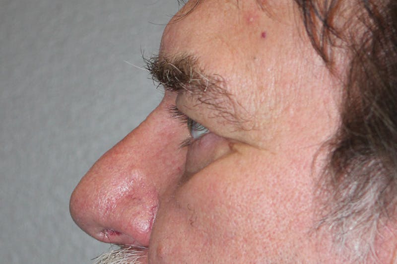 Eyelid surgery Before & After Gallery - Patient 174901504 - Image 10